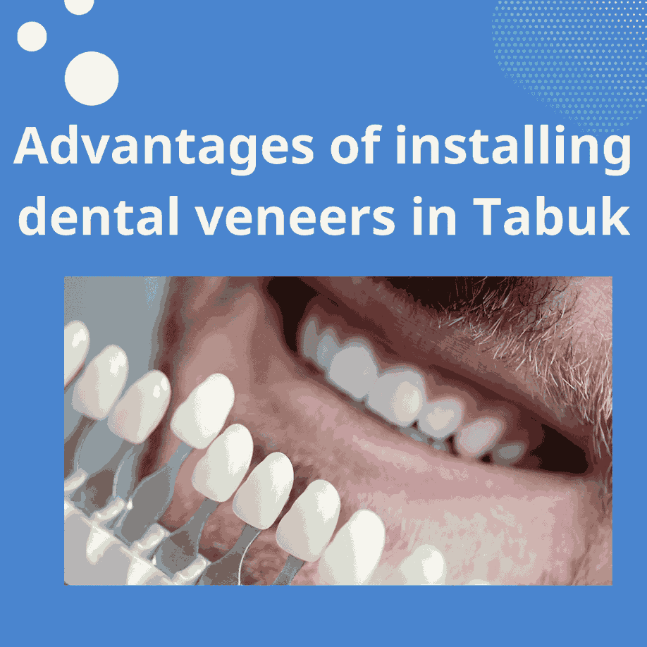 Advantages of installing dental veneers in Tabuk_11zon
