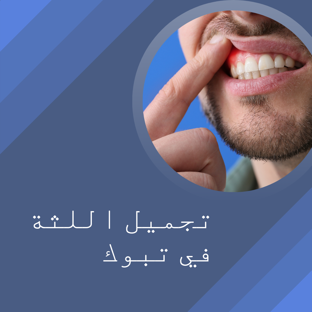 تجميل اللثة في تبوك