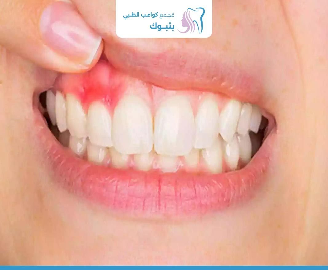 انحسار اللثة