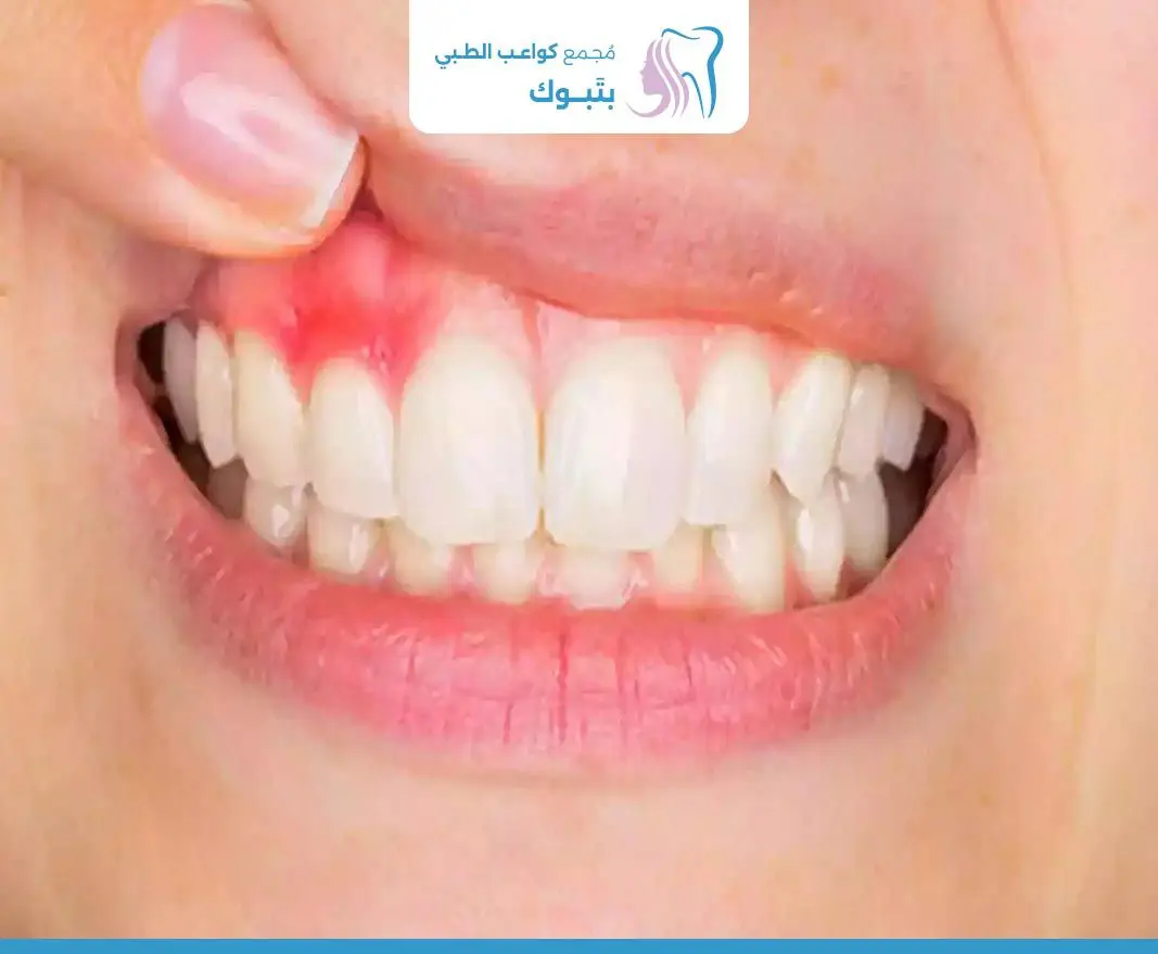 انحسار اللثة