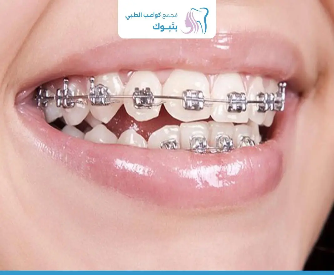تقويم الأسنان